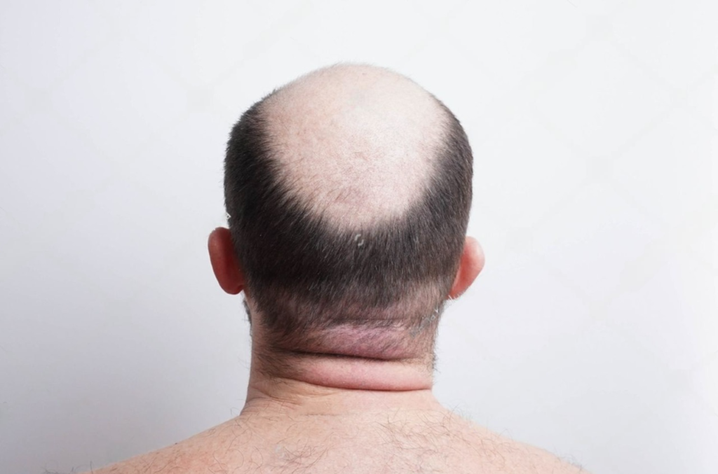 Botak adalah kondisi kepala yang tak ditumbuhi rambut atau rambut yang ada sebelumnya mengalami kerontokan.